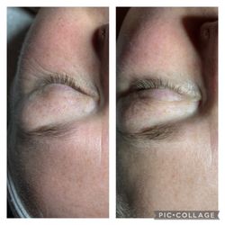 Pure Spa Wellness - Before and after eye treatment
