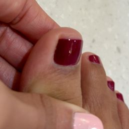 Nail bed exposed Nail bed exposed