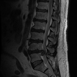 Sierra Spine Institute - L4-5 herniated disc