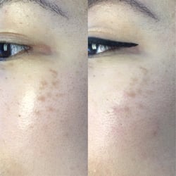 Nova Medical Skin Care - Only 2 treatments and significantly less defined pigments.