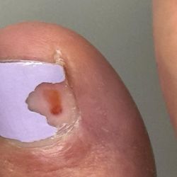 Pedicure .They sawed holes in the nails