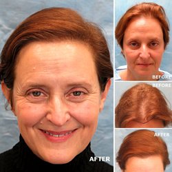 Bernstein Medical - Center for Hair Restoration - Patient ANJ had one hair transplant of 1,745 grafts at Bernstein Medical. See her photos here: https://goo.gl/teJnXe