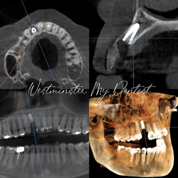 My Dentist - Immediate Dental Implant can replace a missing tooth seamlessly and function as a natural tooth. - General Dentistry Near Me - Westminster, California My Dentist - Immediate Dental Implant can replace a missing tooth seamlessly and function as a natural tooth. - General Dentistry Near Me - Westminster, California