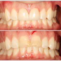 Hatem Abdelhadi, DDS, FICOI - Patient presented with old bonded fillings that kept chipping and staining. We replaced them with 2 veneers!