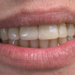 Marshall A Polan, DDS - Huntington Dentist - Veneers After