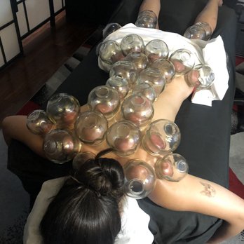 Taylor Made Acupuncture - My back cupping - Acupuncture Near Me Taylor Made Acupuncture - My back cupping - Acupuncture Near Me