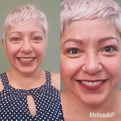 Before & Afters (Hydrafacials & More) - Hydrafacials offer Non-invasive skin resurfacing treatment. It combines cleansing, exfoliation, extraction, hydration and antioxidant protection that removes dead skin cells and impurities, while simultaneously delivering moisturizing serums into the skin. Get Same/ Next Day service or same week appointments with budget friendly prices! Before & Afters (Hydrafacials & More) - Hydrafacials offer Non-invasive skin resurfacing treatment. It combines cleansing, exfoliation, extraction, hydration and antioxidant protection that removes dead skin cells and impurities, while simultaneously delivering moisturizing serums into the skin. Get Same/ Next Day service or same week appointments with budget friendly prices!