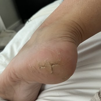Greenfield Nails & Spa - Gilbert - My heel after callous removal. - Nail Salons Near Me - Gilbert, Arizona
