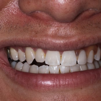 Implantasmile - 10/15/12 - Cosmetic Dentists Near Me - Glendora, California