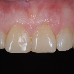 Ryoo Dental - Chipped teeth after cosmetic treatment.