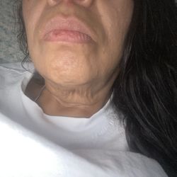 Mariam’s Aesthetic Clinic - After they cause fat loss in my chin awful