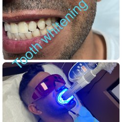 Cuts & Brows - Tooth whitening