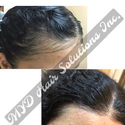 Long Island Hair Loss Center & Wellness - Before & After