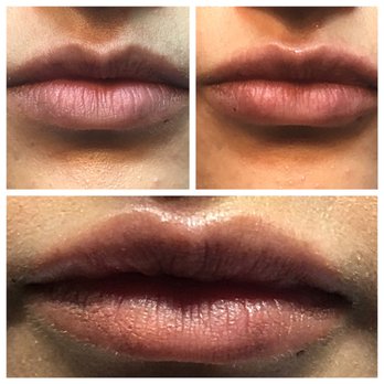 Let'z Face It - this beauty was nervous so we took it slow. top left is prior to treatment, top right is after volbella & the bottom is after juve ultra +. - Medical Spas Near Me - Chandler, Arizona Let'z Face It - this beauty was nervous so we took it slow. top left is prior to treatment, top right is after volbella & the bottom is after juve ultra +. - Medical Spas Near Me - Chandler, Arizona