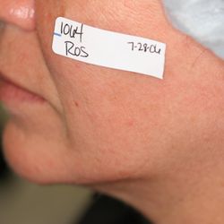 Ohio Laser & Wellness Centers - After Laser Rosacea Treatment