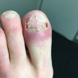 My infection. My infection.