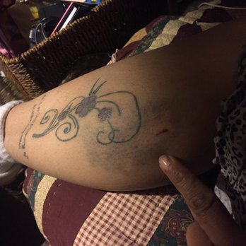 Coronado Campground - This is the dog bite two days after it happened and it is still bruised! - Campgrounds Near Me - Bernalillo, New Mexico