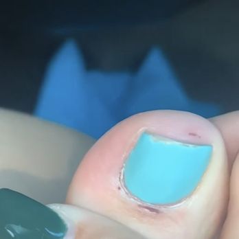 Nail Bar - Cuts on toe - Nail Salons Near Me - Menifee, California Nail Bar - Cuts on toe - Nail Salons Near Me - Menifee, California