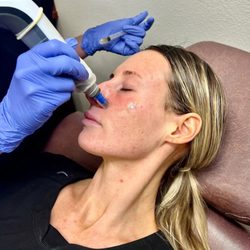 Microneedling treatments can improve the look of acne scarring, uneven texture, enlarged pores, and dull skin with care from ...