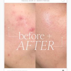 The Glow Method By Aquene - Look at these results from only three facials!