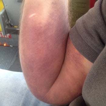Biomat USA - 10-12 days later. Im a big boy. Yeah it hurt as bad as it look. Tnx for $90 without having to donate. Ive spent 85 to treat - Blood & Plasma Donation Centers Near Me - Orange, California Biomat USA - 10-12 days later. Im a big boy. Yeah it hurt as bad as it look. Tnx for $90 without having to donate. Ive spent 85 to treat - Blood & Plasma Donation Centers Near Me - Orange, California