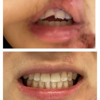 Nicholas Gih, DDS - Before and after. Awesome patient who had an accident with damage to her front teeth. Things look great again and she is healing well! - General Dentistry Near Me - Claremont, California