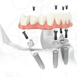Smiles by Hazen - Teeth in a Day Dental Implants