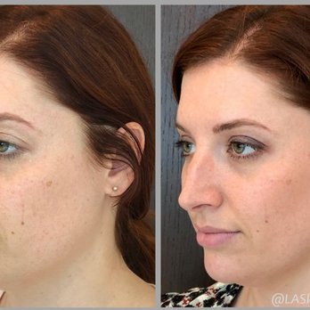 LA SkinAesthetics - Lower face rejuvenation: dermal fillers used to define jawline, give chin projection, and slim face - Medical Spas Near Me - Beverly Hills, California LA SkinAesthetics - Lower face rejuvenation: dermal fillers used to define jawline, give chin projection, and slim face - Medical Spas Near Me - Beverly Hills, California