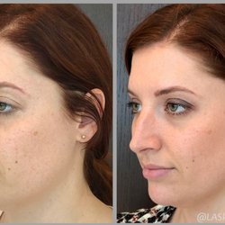 LA SkinAesthetics - Lower face rejuvenation: dermal fillers used to define jawline, give chin projection, and slim face