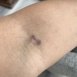Quest Diagnostics - Bruise and swelling
