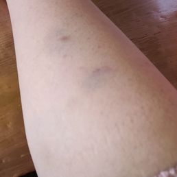 Waxing bruises on right arm, a couple of days after service. Waxing bruises on right arm, a couple of days after service.