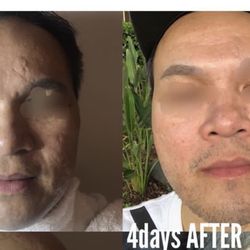 Radiant Beauty Skin Care Med Spa - Fractional RF microneedling