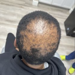 Arizona Aesthetics - 32 year old male before Stem Cell Hair Restoration.