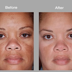 The Aesthetics Corner - Sun Damage Treatment