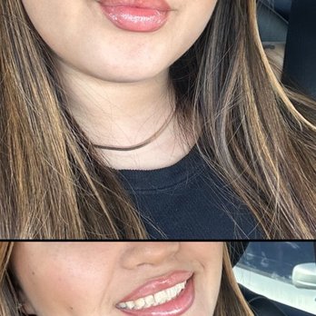 Moderna Laser & Med Spa - After - Laser Hair Removal Near Me - Las Vegas, Nevada