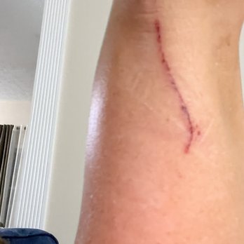 Christian Flooring - The cut in my leg from the staple - Flooring Near Me - Spencerport, New York