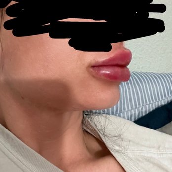 Anew Laser, MD - BOTCHED. The DR who I saw to dissolve my lips said she has no idea what was in my lips. PLEASE BEWARE!!!!!!! - Medical Spas Near Me - El Monte, California