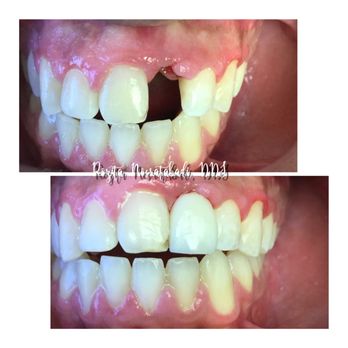 RNA Dentistry - Immediate same day dental implants before & after - Cosmetic Dentists Near Me - Los Angeles, California RNA Dentistry - Immediate same day dental implants before & after - Cosmetic Dentists Near Me - Los Angeles, California