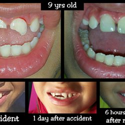 Okan Dental - Incredible restoration done by Dr. Perez on one of our young patients