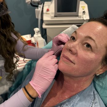 Siren Glow Aesthetics - Injecting EZ Gel (PRF) in the under eye area for under eye rejuvenation - Medical Spas Near Me - Augusta, Georgia