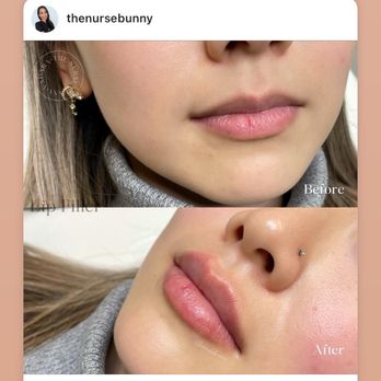 Vadara Med Spa - We offer Botox, Filler, Lip Filler, PDO Threads, PRP, Kybella, Juvederm, etc - Medical Spas Near Me - Mill Creek , Washington Vadara Med Spa - We offer Botox, Filler, Lip Filler, PDO Threads, PRP, Kybella, Juvederm, etc - Medical Spas Near Me - Mill Creek , Washington