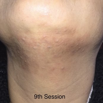 Laser Remedy MedSpa - 9th Session - Laser Hair Removal Near Me - Philadelphia, Pennsylvania Laser Remedy MedSpa - 9th Session - Laser Hair Removal Near Me - Philadelphia, Pennsylvania
