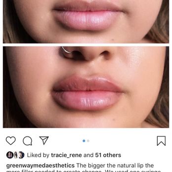 Macro Med - Pic of my new lips! - Medical Spas Near Me - Corona, California