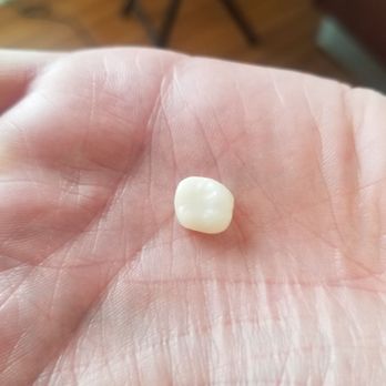 Carlsbad Beach Dental - Drew Addy - Crown that was made while I waited, same day! - General Dentistry Near Me - Carlsbad, California