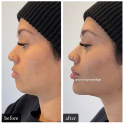 Skin Religion Medical Spa & Wellness - Russian Lips + Chin Augmentation