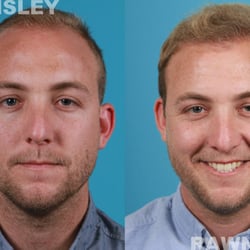Rawnsley Hair Restoration - Hair Transplant Before & After | Rawnsley Hair Restoration
