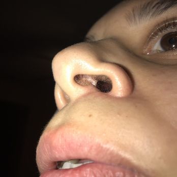 Gold Med Surgery Center - A piece of meat sticking almost out of my nose. - Cosmetic Surgeons Near Me - Encino, California Gold Med Surgery Center - A piece of meat sticking almost out of my nose. - Cosmetic Surgeons Near Me - Encino, California