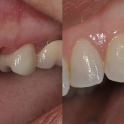 Michael Abelson, DDS MS - Single Implant: Before and After