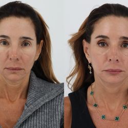 Madnani Facial Plastics - 64 years old 2 months after Facelift, Necklift, Fat Transfer and Co2 laser skin resurfacing with Dr. Madnani