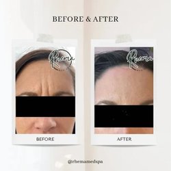 Rhema Aesthetics and Wellness - Before and after Botox results at Rhema Medical & Aesthetics, showing smoother forehead lines. Individual results may vary.